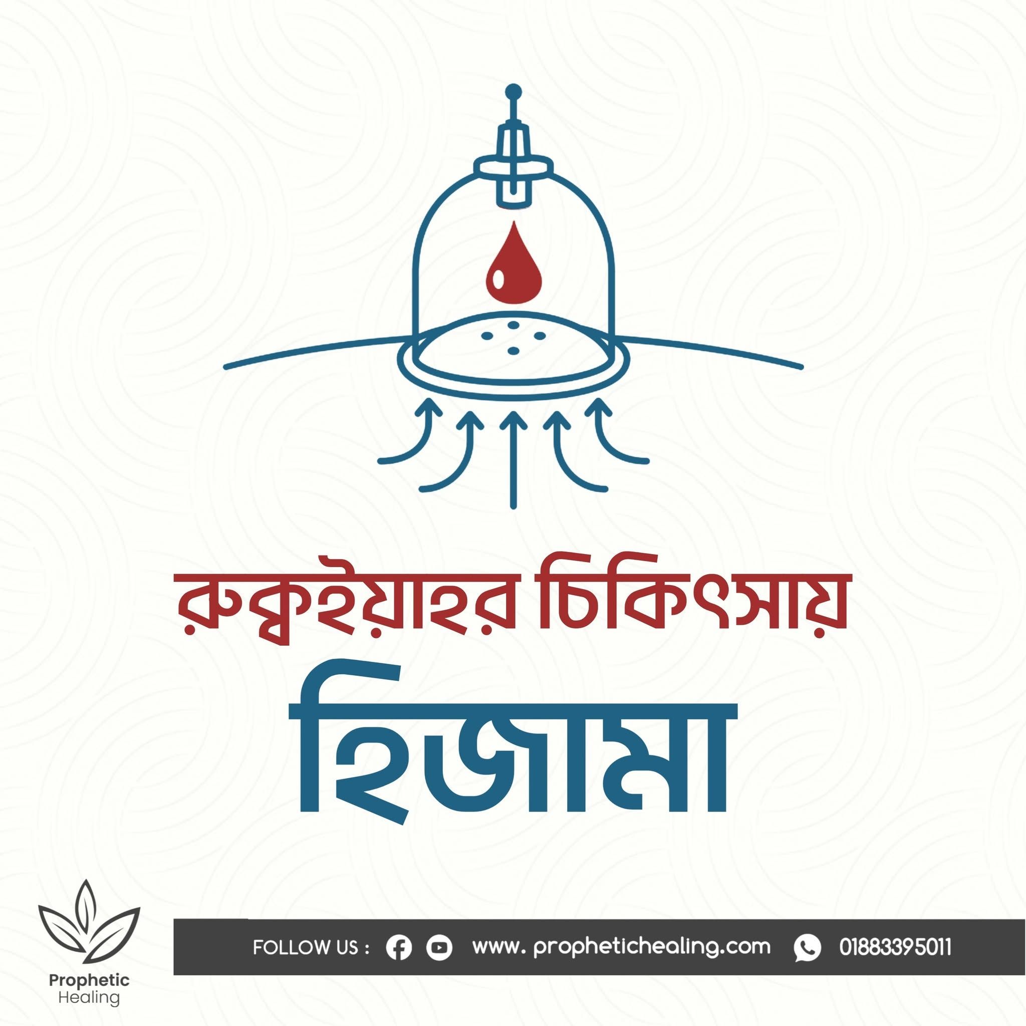 রুকইয়াহর চিকিৎসায় হিজামা